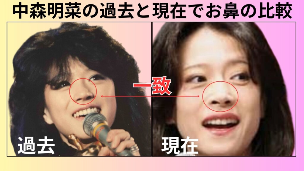 中森明菜は鼻を整形している?