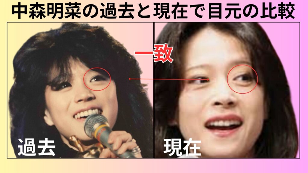 中森明菜目は整形している?